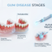 Gum Disease: Early Signs, Stages, and Treatment Options