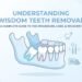 Wisdom Teeth Removal: When You Need It