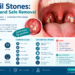 Tonsil Stones: Causes and Safe Removal